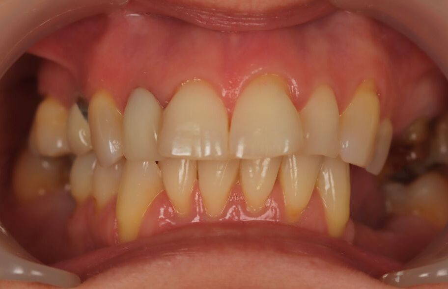 Before - Dentblanche