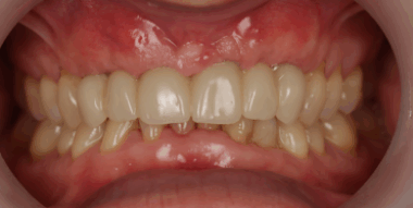 dentblanche
