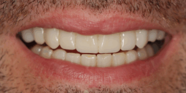 dentblanche