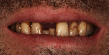 dentblanche